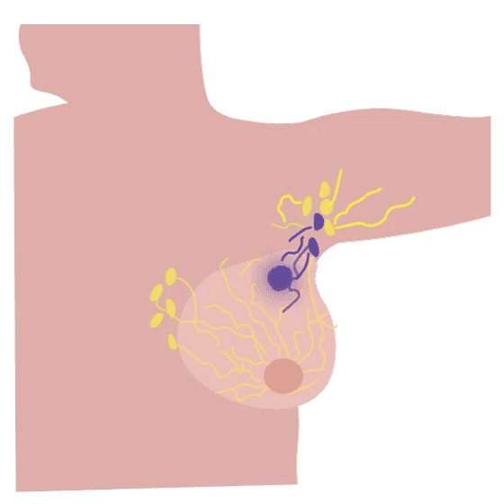 Biopsia del linfonodo centinela
