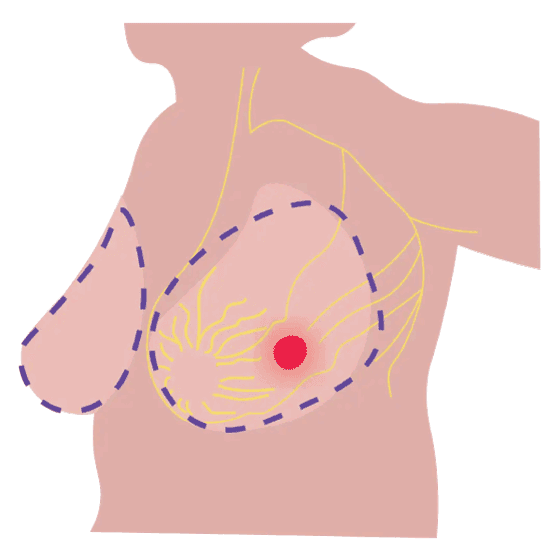 Ilustración mastectomía simple